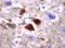 Falsche Faltung von Protein-Bruchstücken (beta-Amyloid) führt zu Plaques, wie sie typisch für Alzheimer sind. © Dr. Jakob Matschke / UKE Hamburg