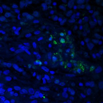 Gliomzellen 400fach vergrößert: Grün fluoreszierender Farbstoff zeigt sterbende Zellen. © Felicitas März