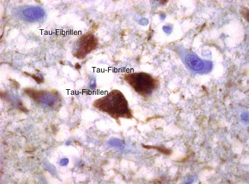Falsche Faltung von Protein-Bruchstücken (beta-Amyloid) führt zu Plaques, wie sie typisch für Alzheimer sind. © Dr. Jakob Matschke / UKE Hamburg