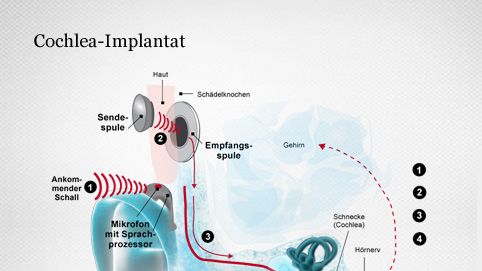 Informationsverarbeitung im Cholea-Implantat