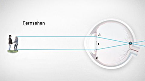 Linsen-Akkomodation des Auges für scharfes Sehen