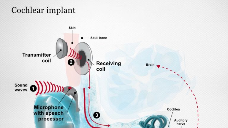 Information processing in the Cholea implant