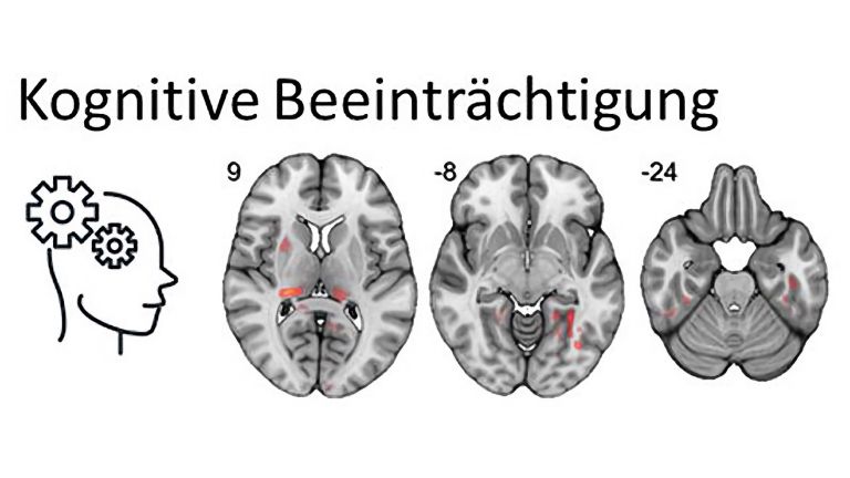 Nach einer Infektion mit COVID-19 besteht ein Zusammenhang zwischen einer veränderten Mikrostruktur in spezifischen Netzwerken des Gehirns mit kognitiven Beeinträchtigungen, Geruchsverlust und Fatigue. Je heller der Bereich, desto stärker der Zusammenhang.