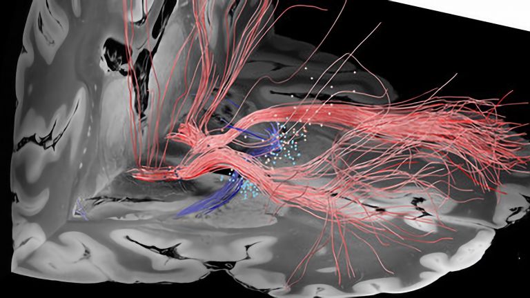 Fasertrakte im Zielgebiet der Hirnstimulation: Dargestellt sind die Elektrodenkontakte bei 50 Patienten mit Zwangsstörungen sowie stimulierte Fasern mit positiven (rot) und negativen (blau) klinischen Ergebnissen.