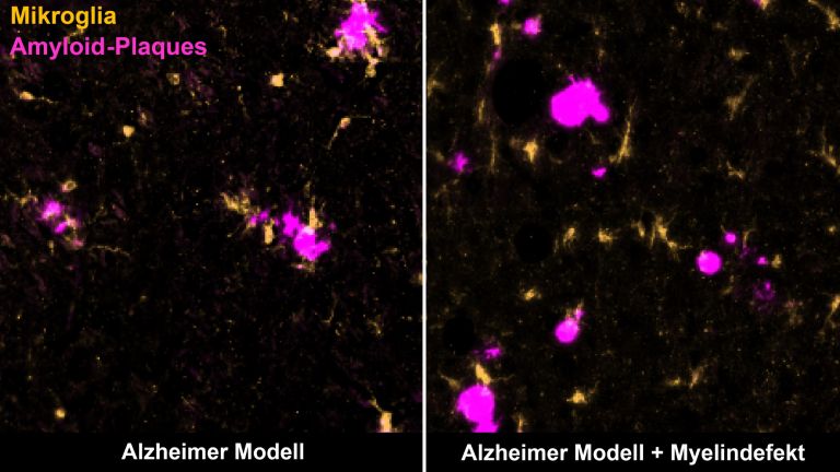 Bestimmte Immunzellen, die Mikroglia (gelb), beseitigen Amyloid-Plaques (magenta) im Gehirn einer Alzheimer-Maus (links). Degenerierendes Myelin lenkt sie davon ab (rechts).