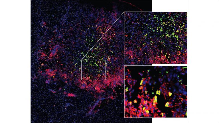 Mikroglia und Makrophagen wandern in einen Hirntumor ein und werden dabei umprogrammiert. Rot: Aktivierter Zustand; grün: Immunsuppressiver, “gelähmter” Zustand, gelb: Übergang zwischen aktiviertem und immunsuppressivem Zustand.