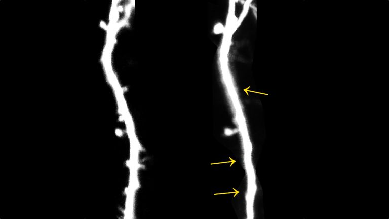 Neuron einer Maus: - Zwischen den beiden Aufnahmen liegen 14 Tage, in denen das Tier für 10 Tage gestresst wurde. Die markierten Fortsätze mit den Synapsen sind in dieser Zeit verloren gegangen.