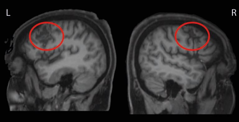 Anatomisches Bild vom Gehirn der Patientin, aufgenommen mithilfe der Magnetresonanztomographie. Die roten Kreise kennzeichnen die Läsionen auf beiden Hirnseiten, die durch die Schlaganfälle verursacht worden (L - linke Gehirnhälfte; R - rechte Gehirnhälfte).
